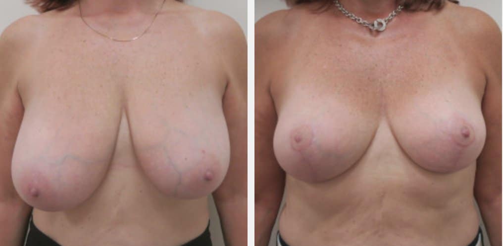 breast 2