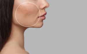 Woman with acne scars seeking laser treatment from Dr. Motakis