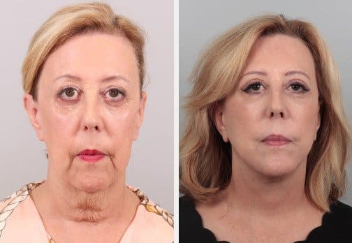 1762378406_facelift-1