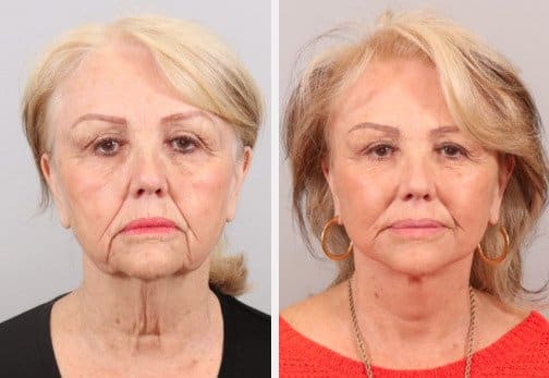 1762378412_facelift-2