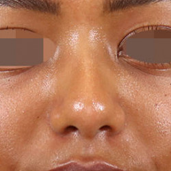 Non surgical rhinoplasty (filler)