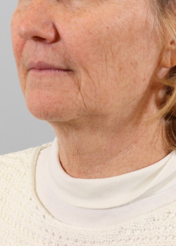 Face & Neck Lift and CO2 Laser Resurfacing around the mouth