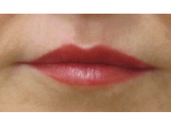 Lip augmentation (filler)