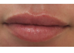 Lip augmentation (Filler)