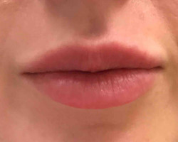 Lip augmentation (filler)