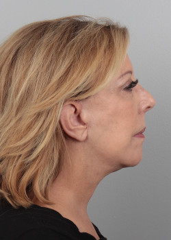 Face and necklift