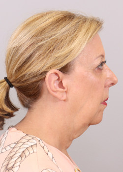 Face and necklift