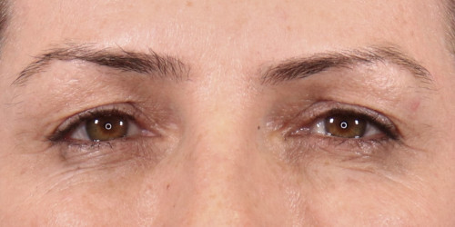 Upper/Lower Blepharoplasty with Lower Eyelid CO2 laser resurfacing