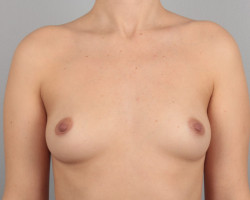 Bilateral breast augmentation