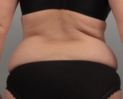 Abdominoplasty & Liposuction