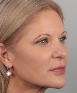 Facial fat grafting, Laser resurfacing & Upper/Lower blepharoplasty