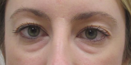 Lower blepharoplasty (transconjunctival) & Fat grafting around the eyes