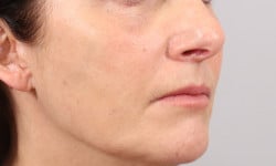 Facial fat grafting and lower transconjunctival blepharoplasty