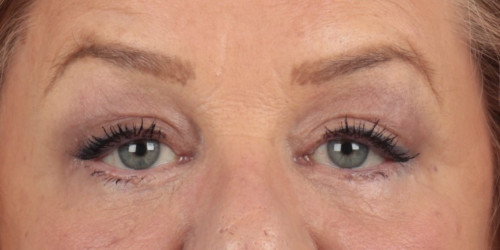 Upper and Lower Blepharoplasty (with Ptosis Repair)